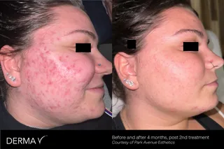 dermav-b-a-park-avenue-esthetics-hope.jpg