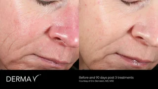 prd-2419-dermav-before-and-after-01.png
