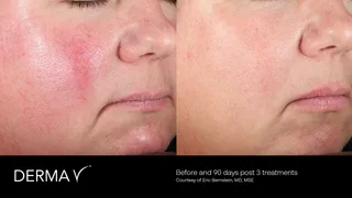 prd-2419-dermav-before-and-after-02.png