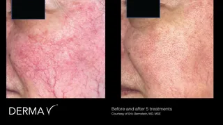 prd-2419-dermav-before-and-after-03.png