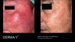 prd-2419-dermav-before-and-after-04.png