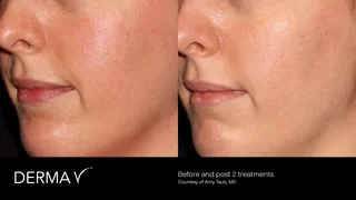 prd-2419-dermav-before-and-after-05.png