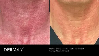 prd-2419-dermav-before-and-after-06.png