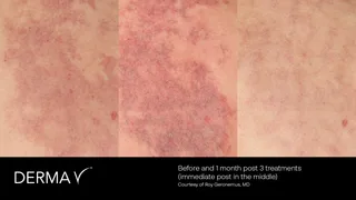 prd-2419-dermav-before-and-after-07.png