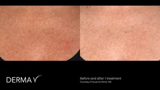 prd-2419-dermav-before-and-after-08.png