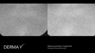 prd-2419-dermav-before-and-after-09.png