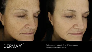 prd-2419-dermav-before-and-after-10.png
