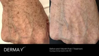 prd-2419-dermav-before-and-after-11.png