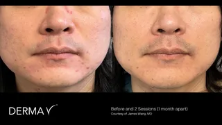 prd-2419-dermav-before-and-after-12.png