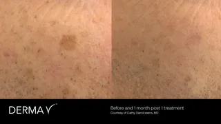 prd-2419-dermav-before-and-after-13.png