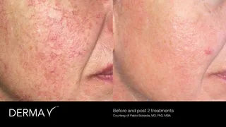 prd-2419-dermav-before-and-after-14.png