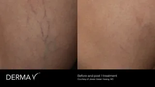 prd-2419-dermav-before-and-after-15.png