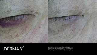 prd-2419-dermav-before-and-after-16.png