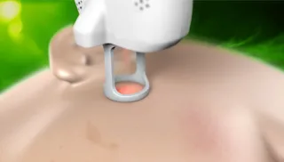 screenshot-lutronic-dermav.png
