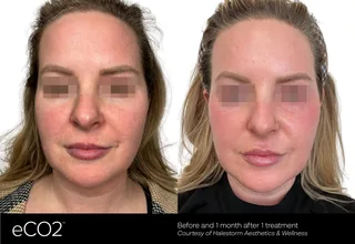 eco2-3d-b-a-halestorm-aesthetics-wellness.png