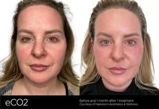 eco2-3d-b-a-halestorm-aesthetics-wellness-no-eye-pixel.png