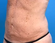 ba5before.png