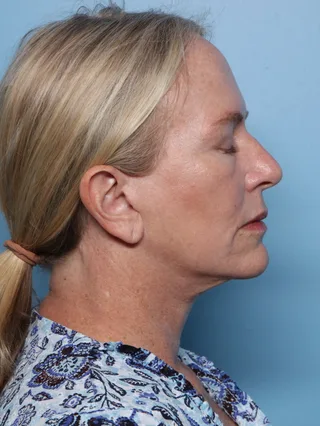 008-rzw-xerf-after-one-treatment.jpg